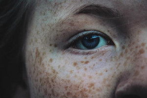 skin conditions freckles | Laser and Mohs NY