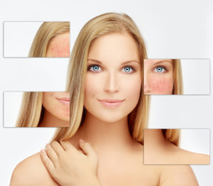 Rosacea | Laser & Mohs Dermatology of New York