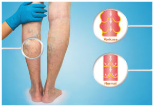 Leg Vein Removal New York City, NY