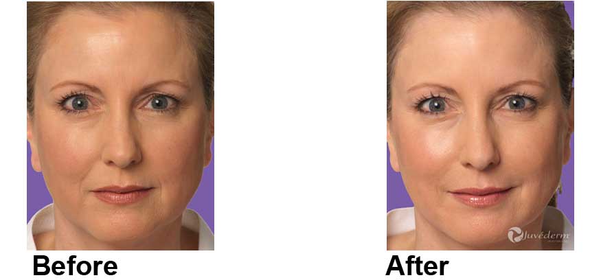 Juvederm New York City