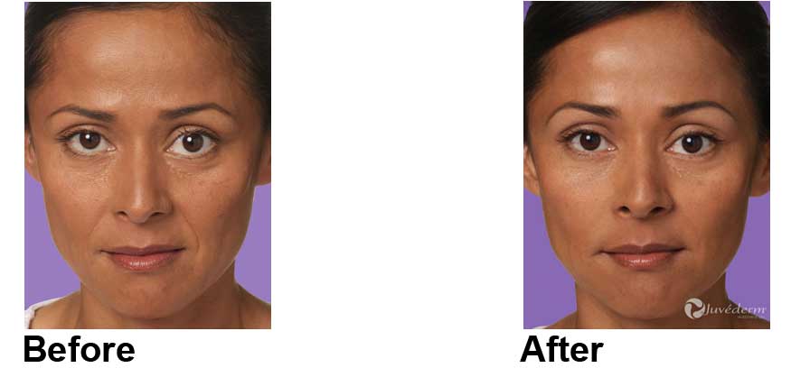 Juvederm New York City