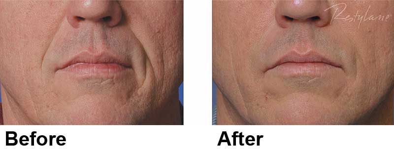 Restylane NYC