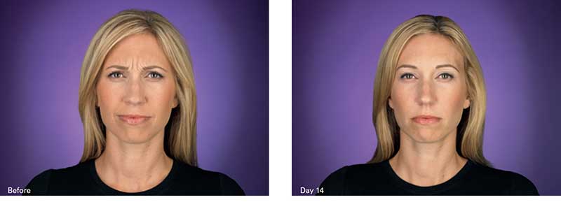 Botox NYC Before & After