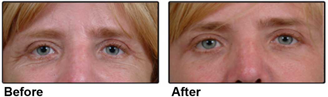 two side by side photos showing before and after of middle aged woman's eyes