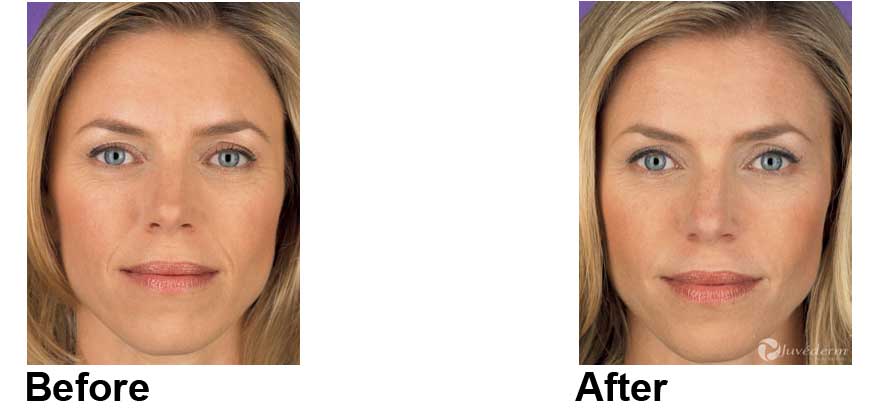 Juvederm New York City