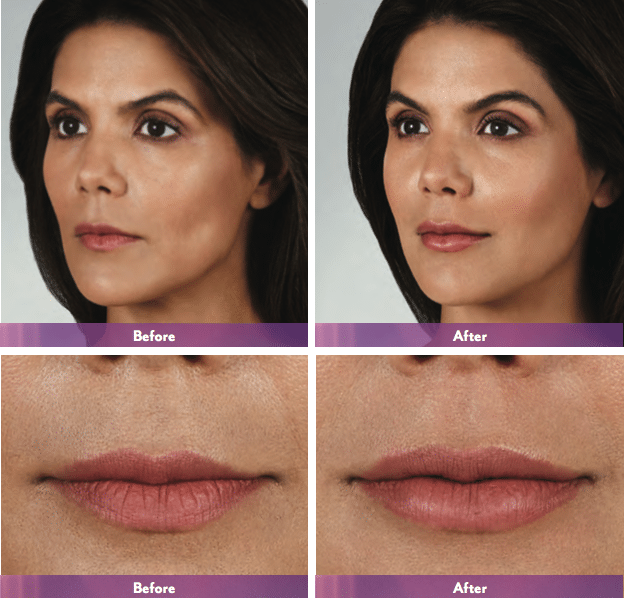 Volbella Treatment in New York City Laser & Mohs Dermatology