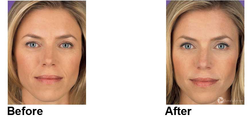 Juvederm Before & After NYC