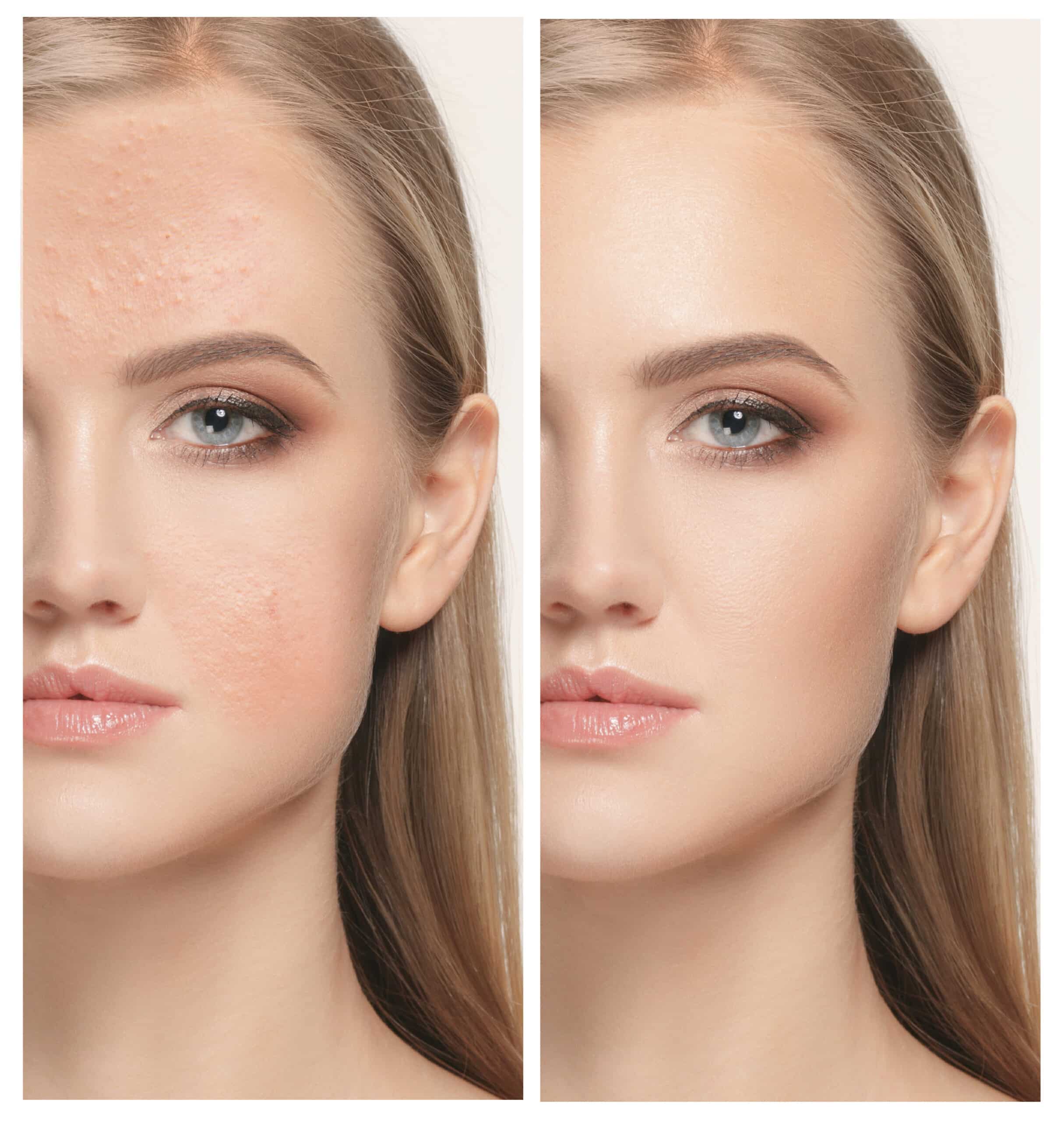 Woman before and after treatment Laser & Mohs Dermatology of New York