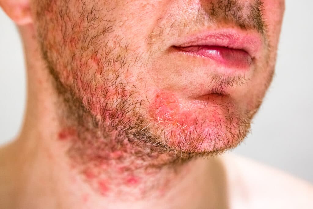 Dermatitis NYC | Seborrheic Dermatitis Treatment Manhattan NY