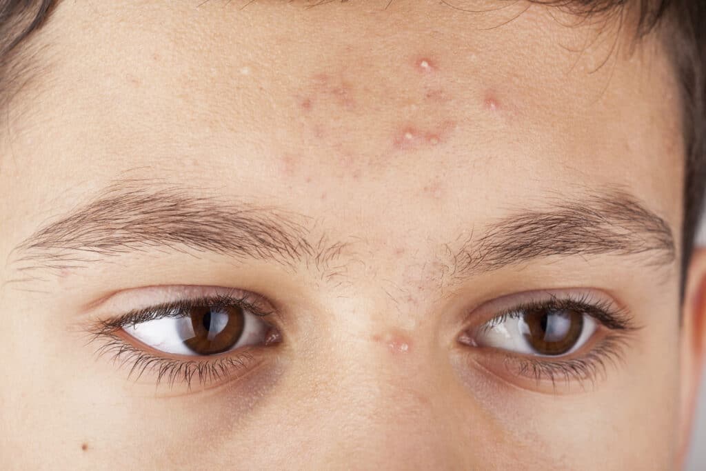 Acne Treatment NYC | Acne Manhattan NY 