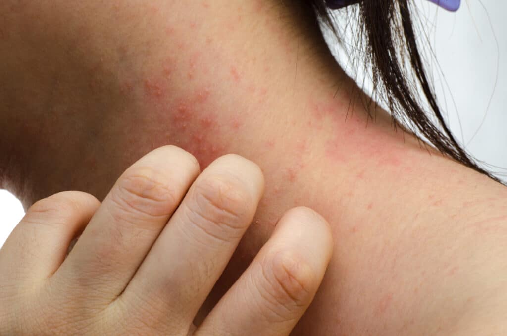 Eczema Treatment NYC | Eczema New York City