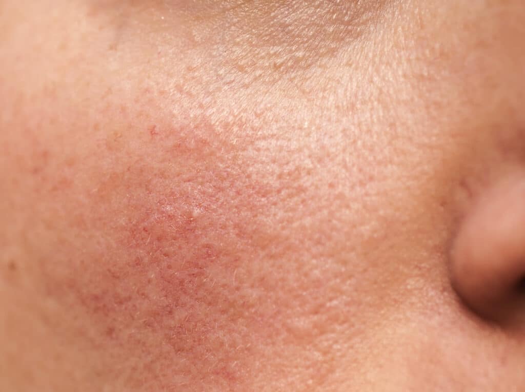 Rosacea Treatment NYC | Rosacea Manhattan NY