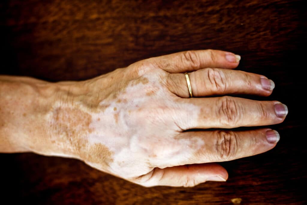 Vitiligo Treatment NYC Vitiligo Treatment NYC