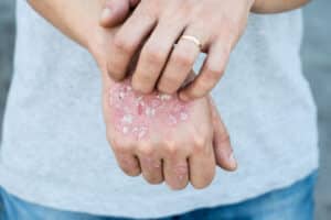 Psoriasis Treatment NYC