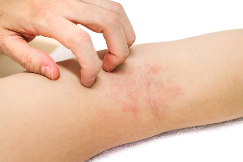 Dermatitis NYC | Contact Dermatitis Treatment Manhattan NY