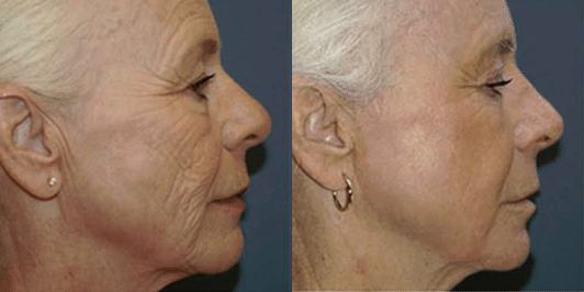  Laser Skin Resurfacing Before & After NYC