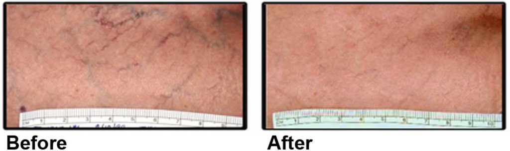 Laser Leg Vein Removal NYC | Laser Vein Removal Manhattan NY