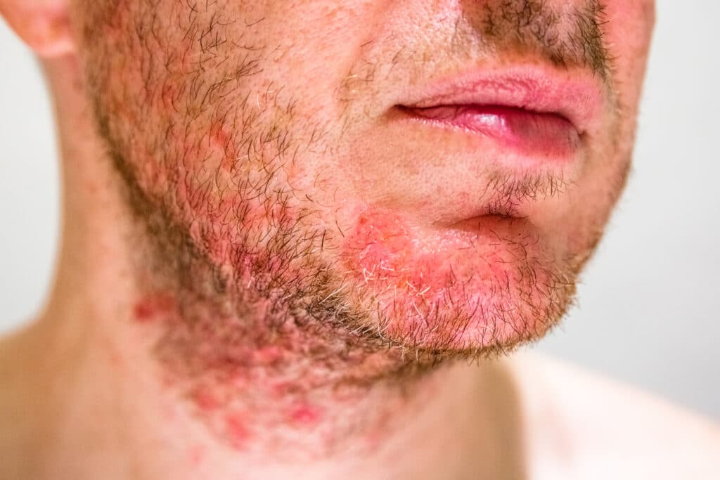 Seborrheic dermatitis NYC