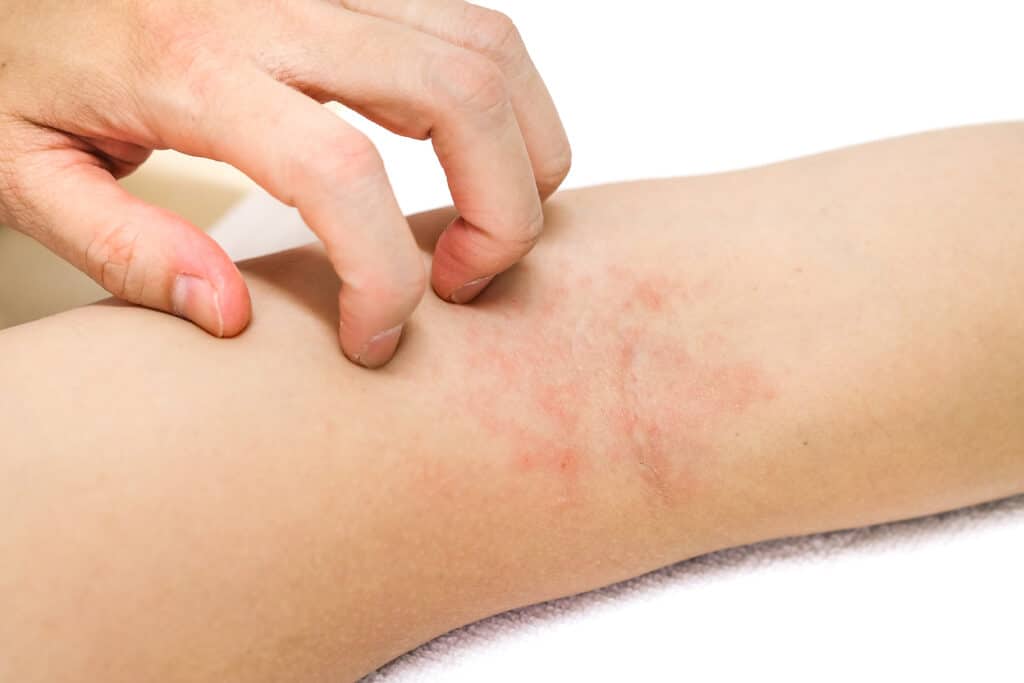 Dermatitis New York City