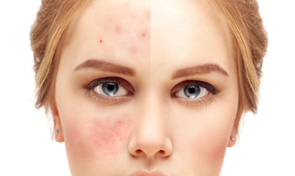 Acne Scar Treatment NYC | Acne Scar Removal Manhattan NY