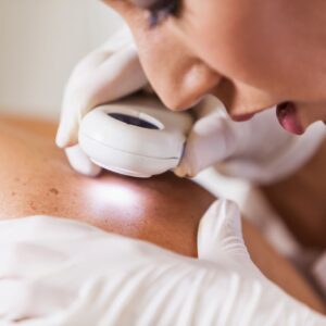 Mole & Wart Removal