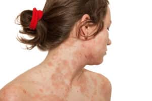 Young girl with Atopic dermatitis, type of eczema. She has her face turned over her shoulder. They Eczema is all over her neck chest and face.