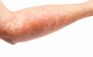 Eczema symptoms on a human forearm. Image is on a white backdrop.