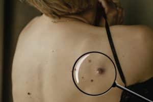 Fibroma and moles with age spots on the female back